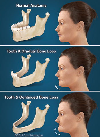 Hidden Consequences of Losing Teeth