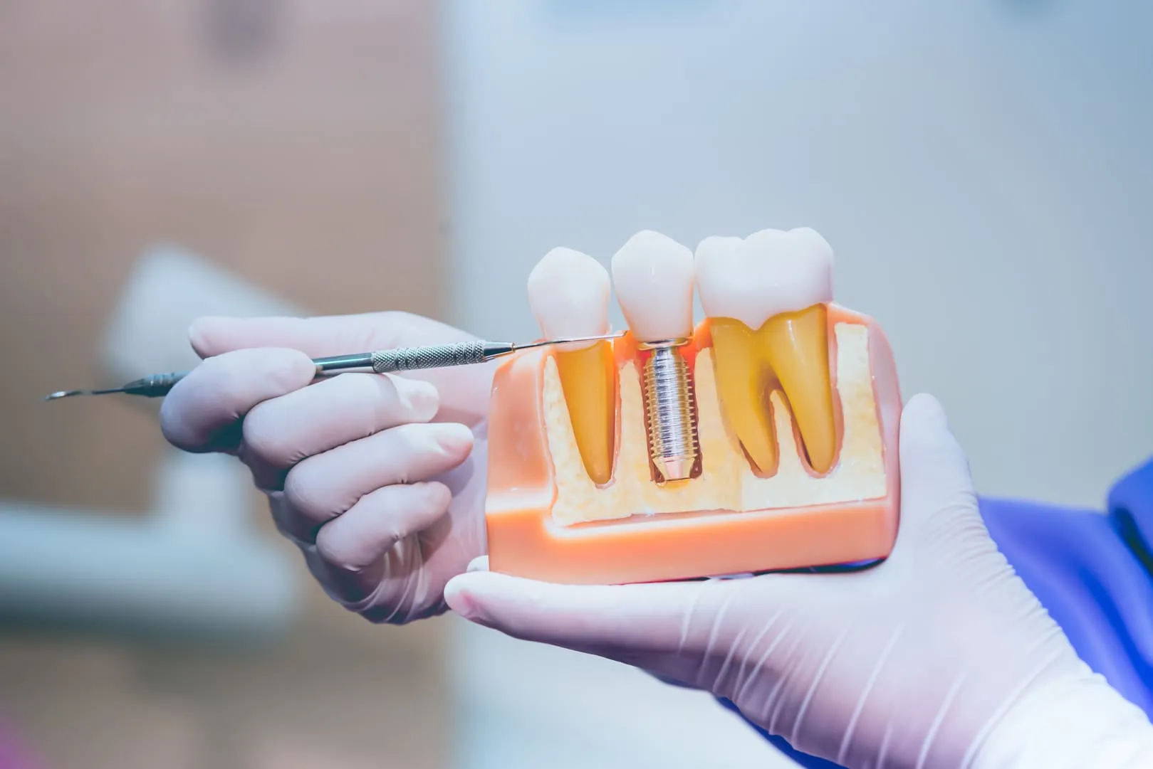 Gloved hands holding a dental model showing a dental implant between natural teeth.
