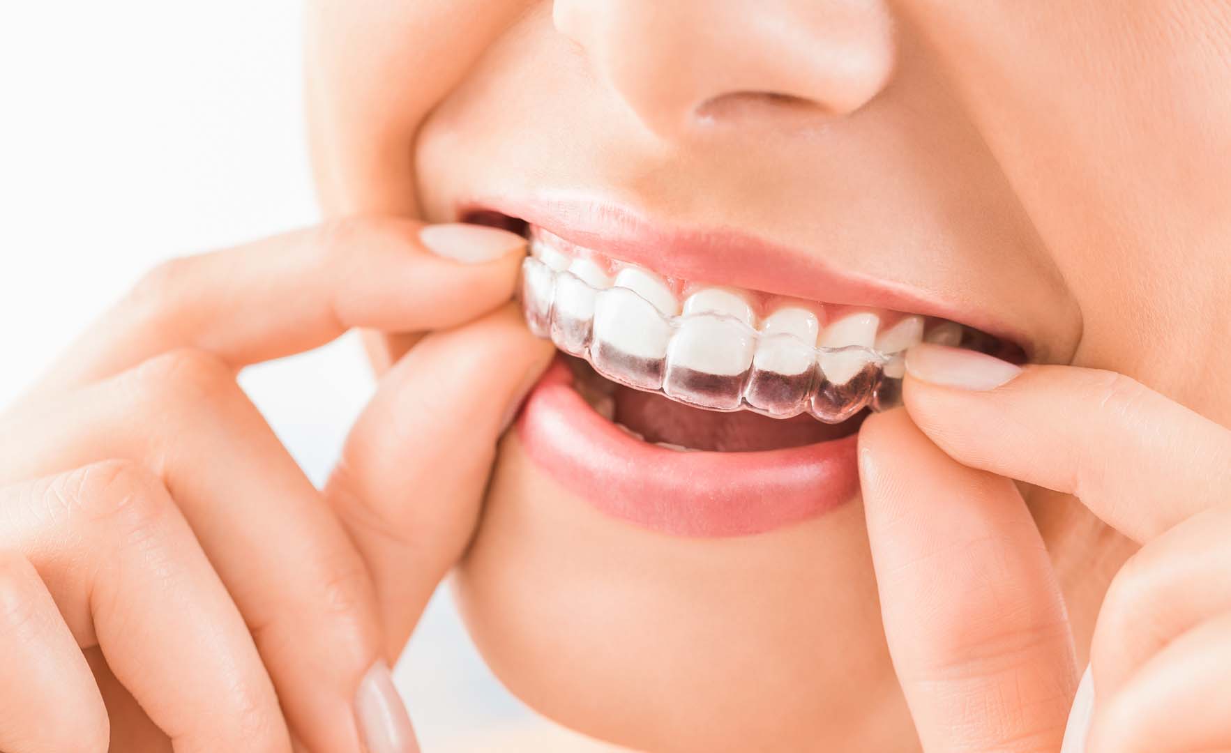 Person inserting a clear dental aligner onto their upper teeth with fingers.